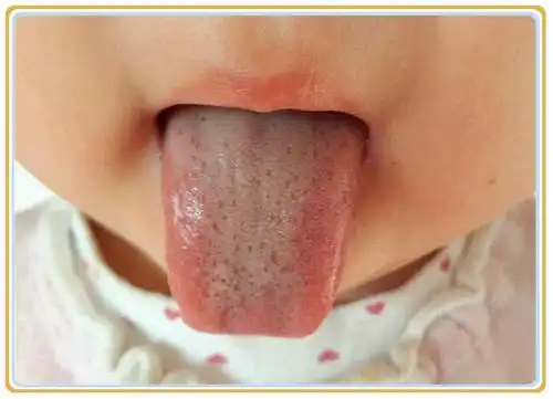 积食问题合集,学会辨别积食很重要!