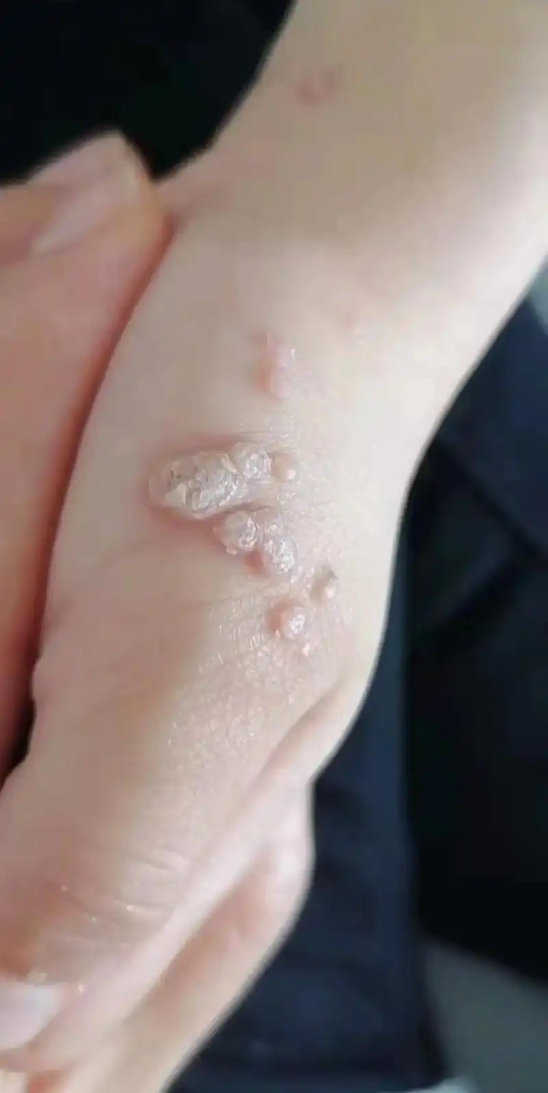 问题性皮肤管理 #病毒疣传染性极强 #劳动人民最光荣  - 抖音