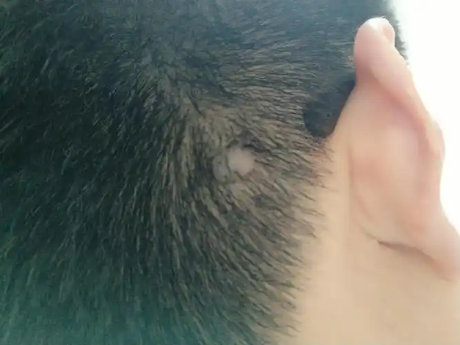 后脑勺就有一个肉瘤