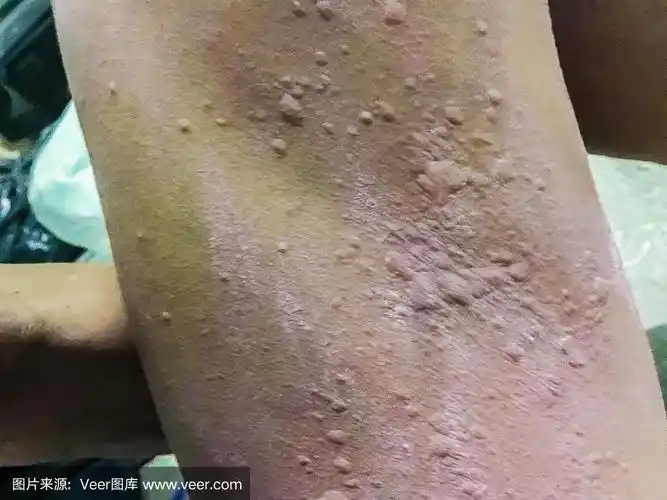 痒性荨麻疹的症状.