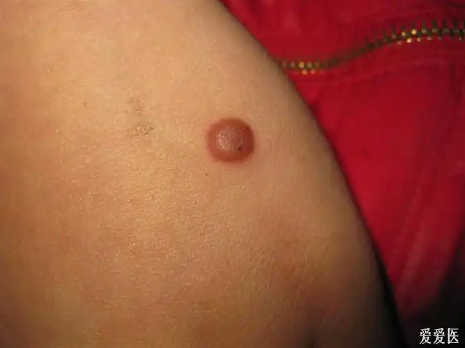 看图识病传染性软疣