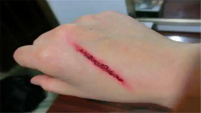 人受伤后伤口如何愈合?显微镜放大500倍,看完涨知识了!