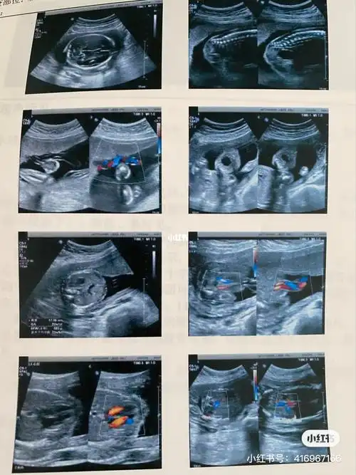 帮看下是男宝还是女宝呢