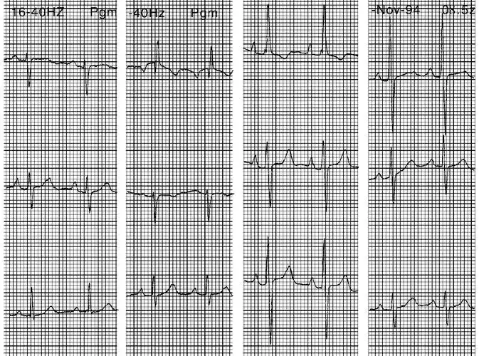 右心室肥厚心电图_挂云帆