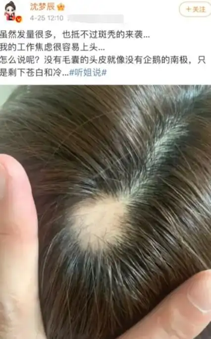 女明星也秃头?杨紫鞠婧祎全靠小心机,杨幂没刘海就是"光明顶"