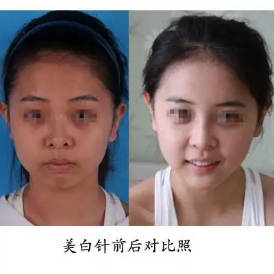 美白针打了真的能白吗看了你就知道