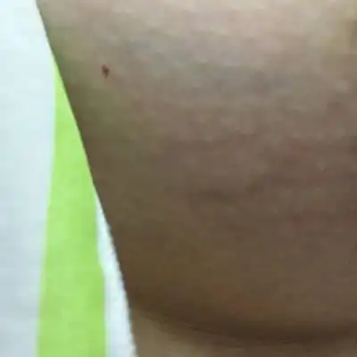 今天突然发现胸上面多了几条,会不会是妊娠纹啊,怎麼办啊怎麼办