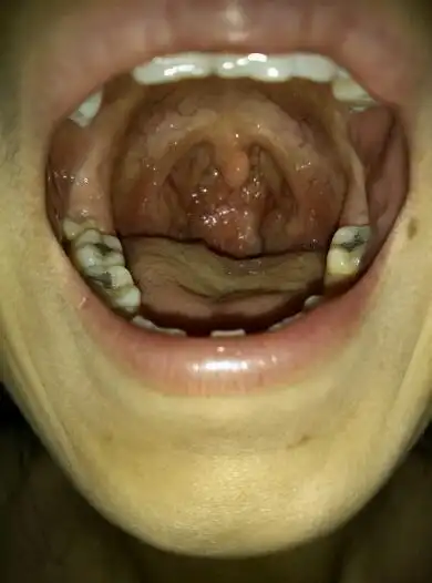 嗓子是这个样子的,是有点扁桃体肿大吗?