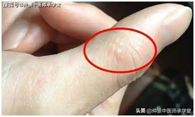 因为挤破会越长越多,又痛又痒,这个在中医上称为是汗疱疹,也