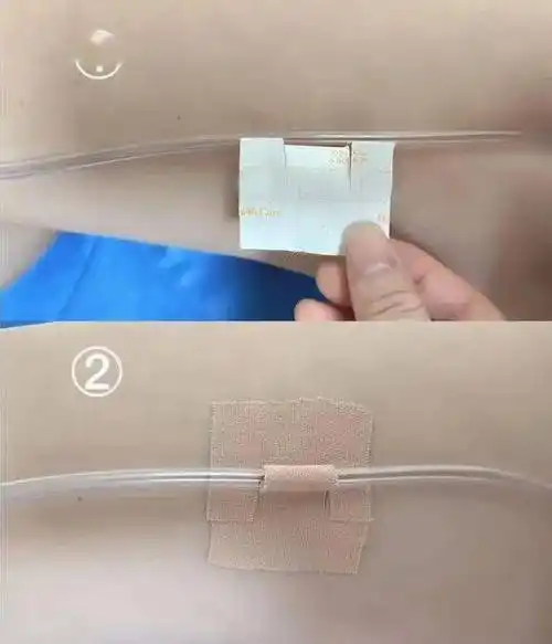 护健图文封控期间导尿管带管患者如何居家自我护理