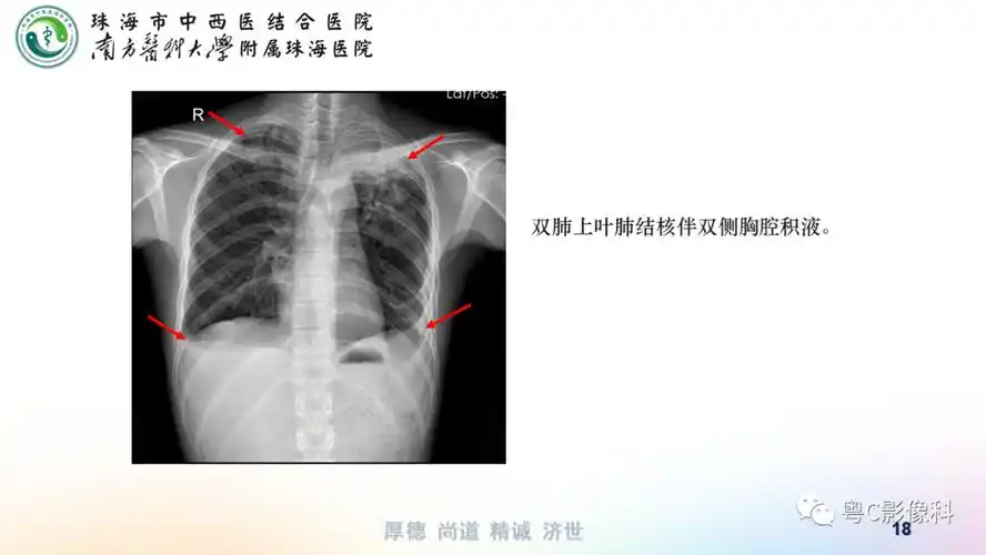 多图一文看懂大叶性肺炎的影像表现