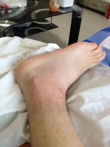 崴脚,外踝撕脱骨折,骨头没事,就是伤筋,一个礼拜后找个中医推拿,现在