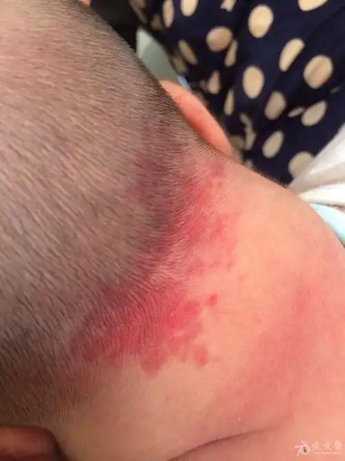 新生儿鲜红斑痣