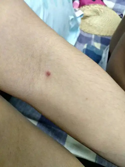 手肘内侧长了一个像痘痘的东西,不痒按下有少少痛,一个星期了不知道是