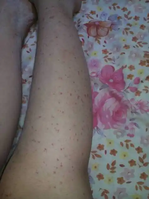 紫癜初期的图片_紫癜初期的图片腿上