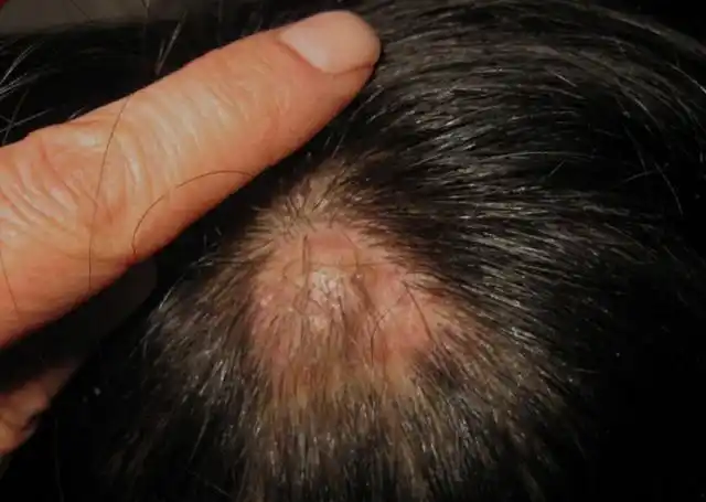 为什么头皮经常长脓包和疙瘩?医生暗示:3种病或要考虑其中