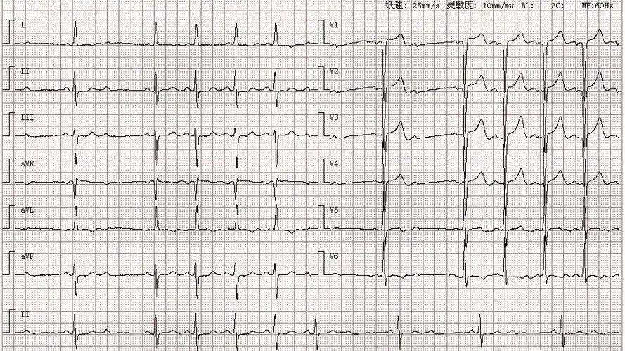心电图图库丨二度ii型(2:1)房室传导阻滞系列 - 知乎