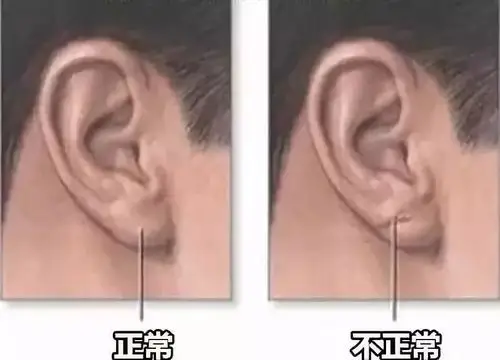 耳朵有"沟"等于心脏病!还不快去照镜子看看你的耳朵?_耳垂