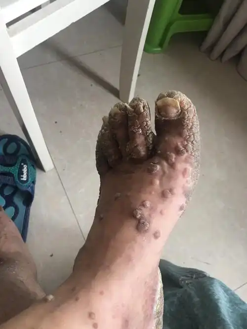 皮肤病疣久治不愈