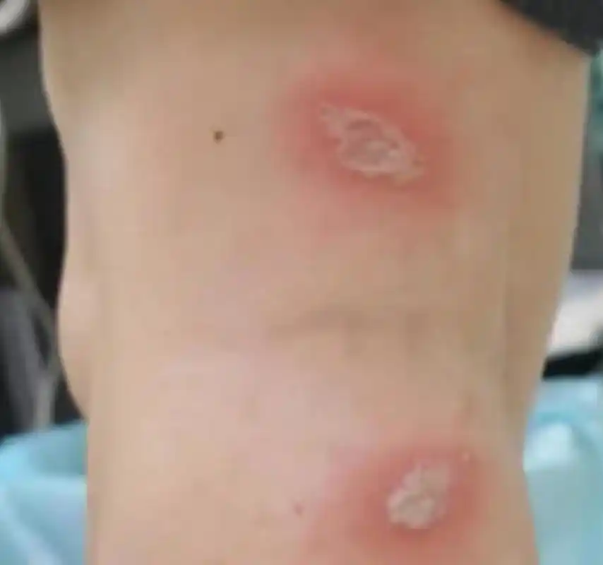 女子捏死隐翅虫手臂被腐蚀7天还没好