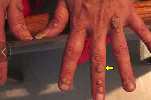 图示为手部皮肤 hpv 感染病损表现(图片来源:medscape)