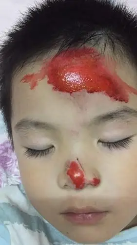 请问小孩额头摔破一大片皮消毒之后搽了红药水,药水干了之后可以用欧