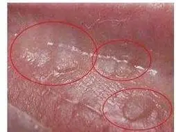 回答病情分析你好,你上述的症状,考虑可能是假性湿疣假性湿疣多见于20