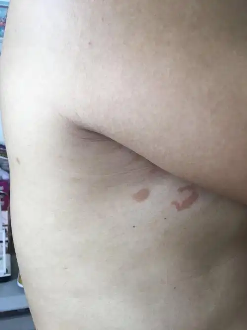 我的腋窝下面一点的皮肤变的有点红,不痛也不痒