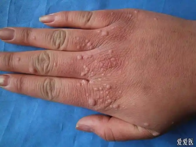 典型病例:寻常疣. - 皮肤及性传播疾病讨论版 - 爱爱医医学论坛