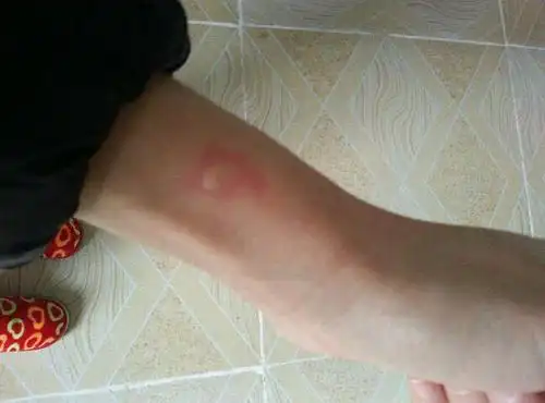 昨晚被暖宝宝烫的起水泡 谁知道怎么把它消掉啊 好痛的