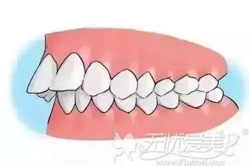 如何判断地包天是牙性的还是骨性的围过来看看这篇