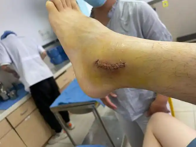 腓骨肌腱滑脱day9