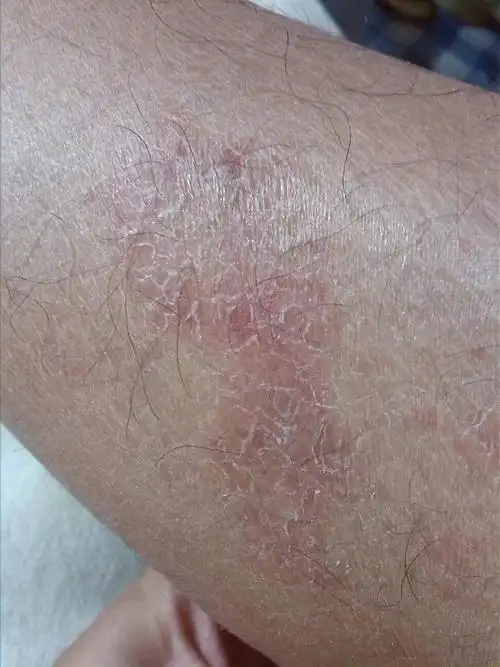 小腿内测出现一块这种大的红的皮,有点像鱼鳞的感觉,不痛也不痒,有两