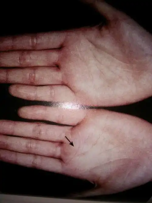 风水玄学  手相掌纹 9线对诊断肿瘤有什么特殊意义科研征实癌症与环境