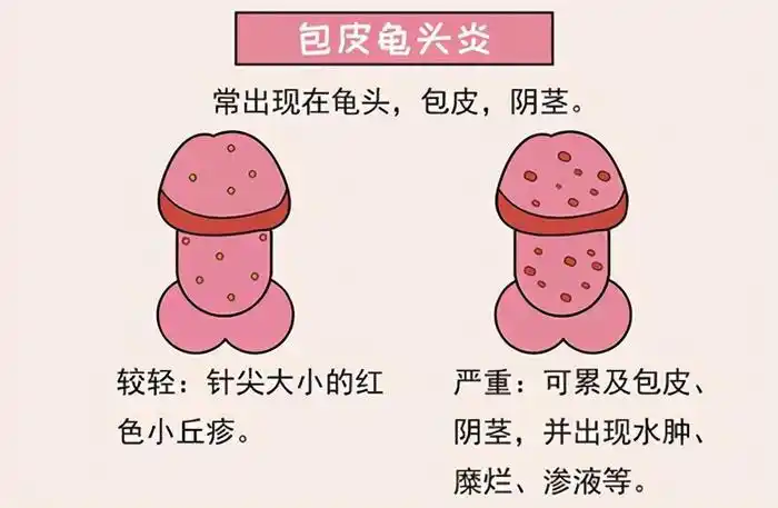 年轻人悠着点shǒu淫可能引起包皮龟头炎把握尺度很重要