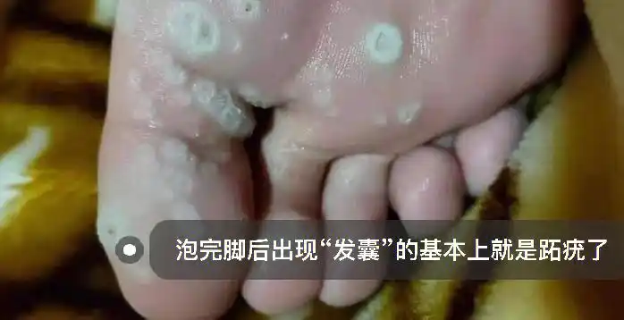 跟烦恼的跖疣说拜拜