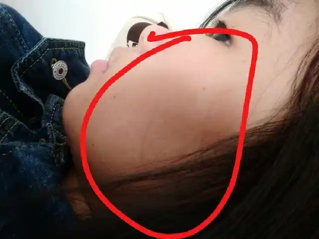 为什么我的脸中间那一块肉会陷进去,笑起来非常难看