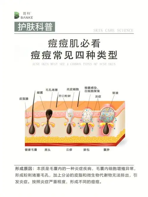 痘痘常见4种类型对症看看你是属于哪一种