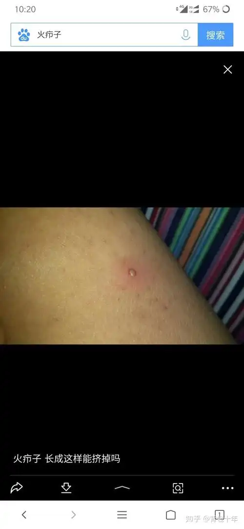 事后过去的一个月,安安稳稳度过!我感觉这东西就是个普通疙瘩发炎了!