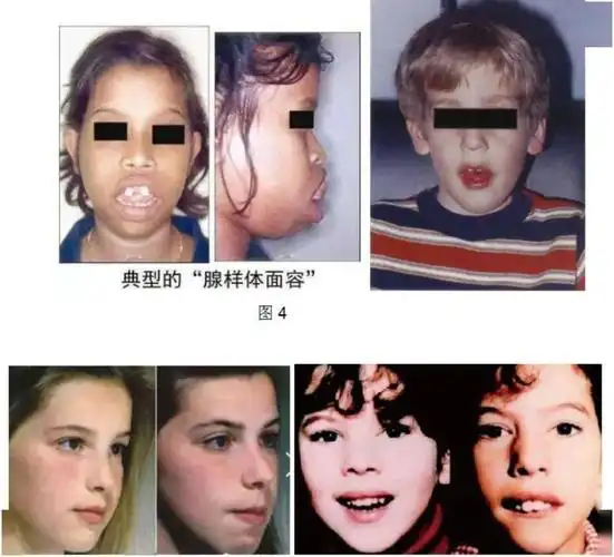 医师再从男孩的临床表现判定,由于他长期张口呼吸,已经出现腺样体面容