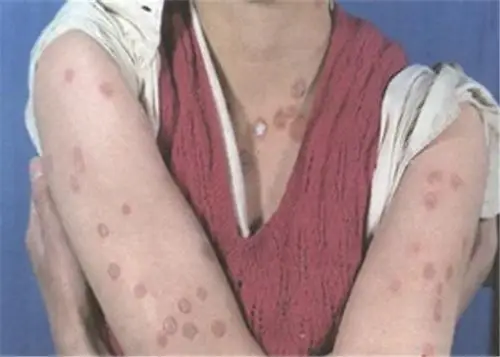 重庆花斑癣医院_重庆治疗花斑癣哪家医院好_重庆治疗花斑癣权威的医院