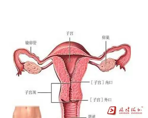 子宫内异症这一顽疾做泰国试管婴儿要怎么提高成功率? >