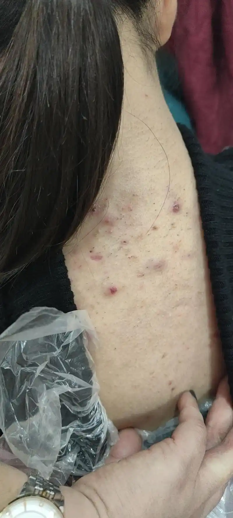 我的女儿,你脸上长得还么严重这么多的痘痘你家人都没看见吗,可 - 抖