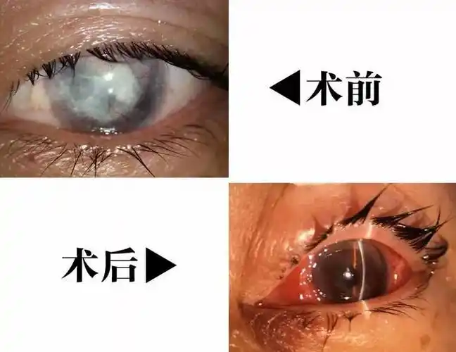 角膜受伤38年 女患者在重庆华厦眼科医院角膜移植后重燃生活信心