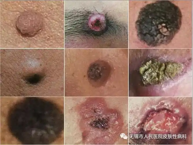 皮肤上出现肿物是皮肤癌? —	— —真相揭秘