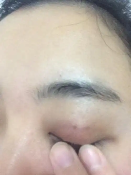 埋线双眼皮27天发现线头出来了一点