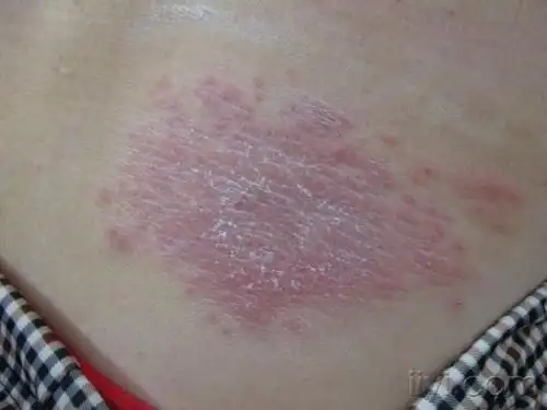 背部红斑丘疹 - 皮肤及性传播疾病讨论版 - 爱爱医医学论坛 - 爱爱医