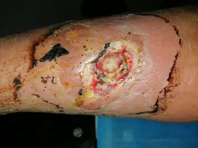 2个感染后创面形成病例报告