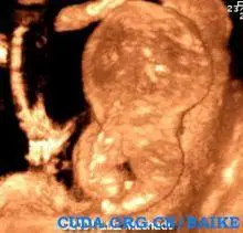 胎儿:颅盖完全或部分缺如,全前脑,无脑,颜面结构缺如,无眼,小眼,唇裂