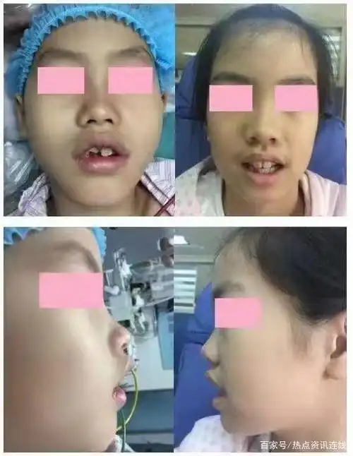 王永月医生谈什么是腺样体肥大以及对孩子有哪些影响